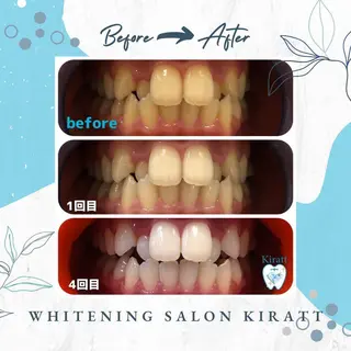 セルフホワイトニングサロンKiratt札幌店💎所属・Kiratt 札幌店のその他イメージ