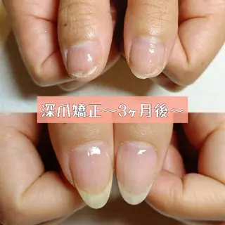ネイル 深爪矯正/爪育成ケア manie nailのネイルデザイン