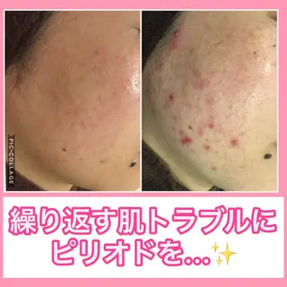 ミディアム カラー パーマ ヘアアレンジ メンズ キッズ ネイル マツエク・マツパ ニキビ・肌質改善専門 ♡人生が変わるサロンのエステ・リラクイメージ