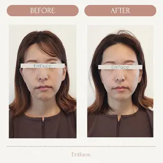 即効⚡小顔美容鍼🪡 むくみたるみ脂肪解消のエステ・リラクイメージ