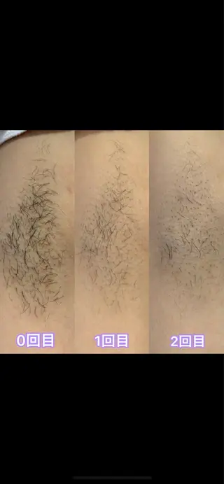 beautysalon FourV所属・名駅🌼無痛美肌脱毛 /フェイシャルのエステ・リラクイメージ