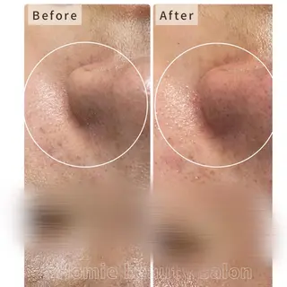 ハーブピーリング🌹 Homieのエステ・リラクイメージ