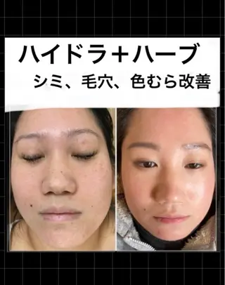 ハーブピーリング 専門店MOKA所属・ハーブピーリング専門 MOKAのエステ・リラクイメージ