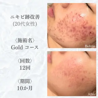 6万人の美肌実績🔥 最短ニキビ改善のエステ・リラクイメージ