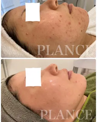 フェイシャル専門 肌質改善/プランスのエステ・リラクイメージ