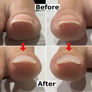 ネイル Mellow nail所属・巻爪無料モデル募集 ✨🦶MEGUMIのネイルデザイン