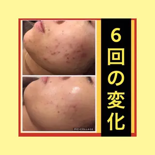 ミディアム パーマ ヘアアレンジ メンズ キッズ ネイル マツエク・マツパ ニキビ・肌質改善専門 ♡人生が変わるサロンのエステ・リラクイメージ