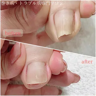 ネイル 深爪・巻き爪 専門サンセリテのネイルデザイン