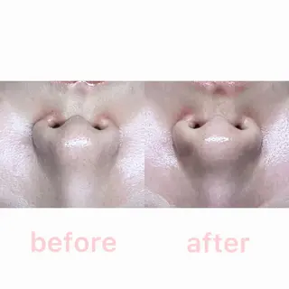 Rifuro 勝田台エステ所属・Rifuro勝田台 ララピール・毛穴洗浄のエステ・リラクイメージ