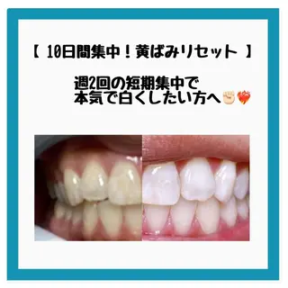 ネイル/耳つぼ /新ホワイトニングのネイルデザイン