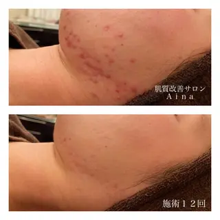 ミディアム カラー パーマ ヘアアレンジ メンズ キッズ ネイル マツエク・マツパ ニキビ跡専門サロン Ａｉｎａのエステ・リラクイメージ