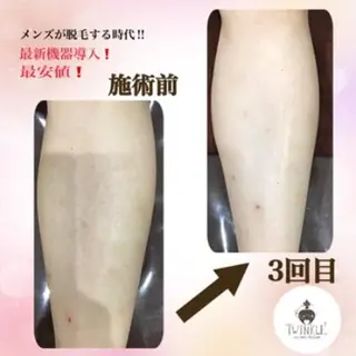 メンズ TWINKLE上尾店 Shimadaのエステ・リラクイメージ