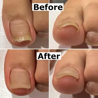 ネイル Mellow nail所属・巻爪無料モデル募集 ✨🦶MEGUMIのネイルデザイン