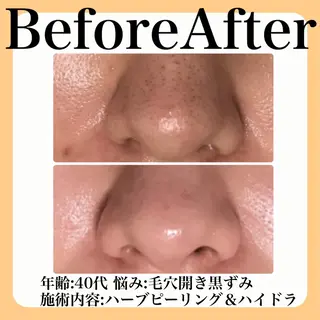 毛穴・たるみ･ニキビケア専門サロンsui所属・sui【スイ】 ARISAのエステ・リラクイメージ