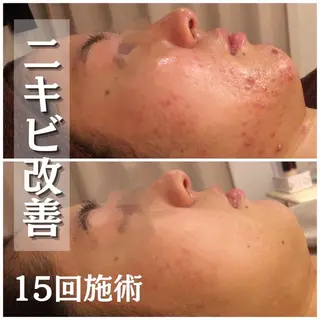 セミロング カラー パーマ ヘアアレンジ メンズ キッズ ネイル マツエク・マツパ アイブロウ ニキビ特化型エステ 🍓最短で肌質改善のエステ・リラクイメージ