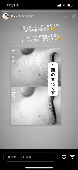 ニキビ跡改善専門🔥 医療にはできない改善のエステ・リラクイメージ