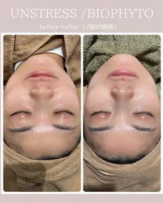 【毛穴•ハーブピーリング】 ニキビ対策サロンétoile クリスティーナ正規取扱店所属・松尾 佳奈のエステ・リラクイメージ