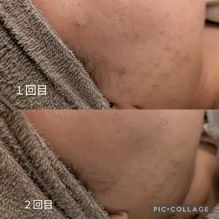 毛穴フェイシャルエステkokotto板橋所属・【毛穴ハーブピーリン グ】板橋1位のエステ・リラクイメージ