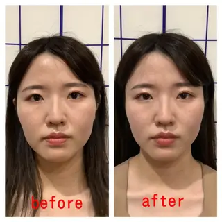 お顔のむくみたるみ 専門☆美容鍼小顔矯正のエステ・リラクイメージ