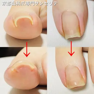 ネイル 深爪・巻き爪 専門サンセリテのネイルデザイン