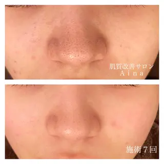 ミディアム カラー パーマ ヘアアレンジ メンズ キッズ ネイル マツエク・マツパ ニキビ跡専門サロン Ａｉｎａのエステ・リラクイメージ