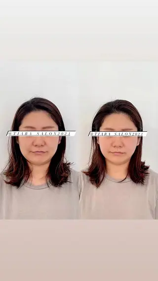 美容鍼灸サロン　TIARA所属・鍼灸サロン TIARA　美容鍼のエステ・リラクイメージ