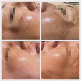 ハーブピーリング　美肌サロン　health and beauty maki所属・ハーブピーリング 美肌サロン　makiのエステ・リラクイメージ