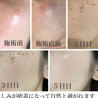 【しみ毛穴専門店】beautysalon Ankh所属・しみ毛穴専門店 Ankh 平田のエステ・リラクイメージ