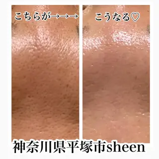 Chalon所属・REVI取扱・肌悩み 毛穴Chalonのエステ・リラクイメージ