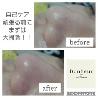 毛穴ケア・肌質改善 徳川のエステ・リラクイメージ