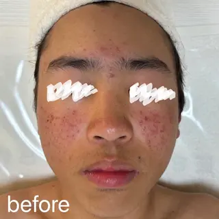 肌質改善|天王寺 For...はるかのエステ・リラクイメージ