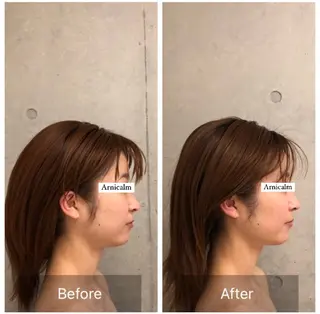 ハーブピーリング 肌再生ピーリング/のエステ・リラクイメージ