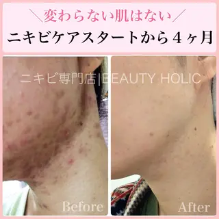 ニキビ・ 肌荒れ専門店のエステ・リラクイメージ
