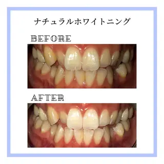 ホワイトニング｜韓国式3D毛穴洗浄 lonhana ﾛﾝﾊﾅ所属・韓国式3D毛穴洗浄 lonhanaのその他イメージ