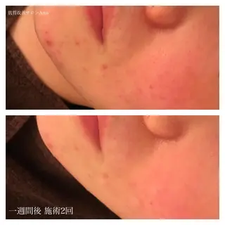 セミロング カラー パーマ ネイル マツエク・マツパ ニキビ跡専門サロン Ａｉｎａのエステ・リラクイメージ