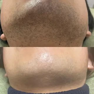 メンズ メンズ脱毛&メンズ眉毛  美的男子所属・メンズ眉＆メンズ脱毛 美的男子のその他イメージ