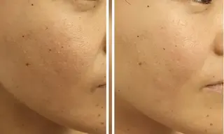 水光肌ピーリング ハーブピーリングのエステ・リラクイメージ