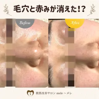 ニキビケア/毛穴/ 赤み/自信の肌✨森園のエステ・リラクイメージ