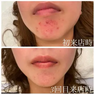 美容鍼/ヘッドスパ/ 💎さかもとのエステ・リラクイメージ