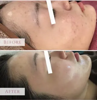 エイジングケアサロンBIOEL所属・肌質改善BIOELプ ラズマ/ラミピールのエステ・リラクイメージ