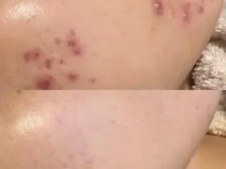 べアール所属・小顔/毛穴/ニキビ salon bealのエステ・リラクイメージ