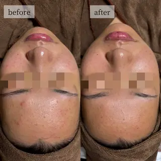 HINANO矢場町店【ヒナノ】所属・脱毛/肌改善🌿 HINANO 村田のエステ・リラクイメージ