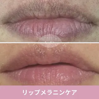 ハーブピーリング肌 管理🌿Ante関内のエステ・リラクイメージ