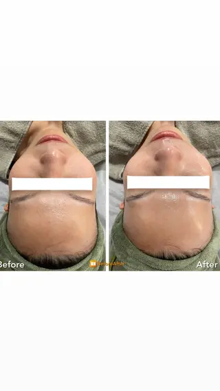 Meupニキビ専門店 背中/ハーブ/肌管理のその他イメージ