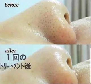 ニキビケア◇ニキビ跡 レゾン京橋店　峠山のエステ・リラクイメージ