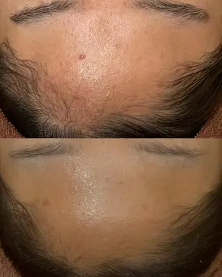 学生ニキビ改善🍀 優しい肌質改善のエステ・リラクイメージ