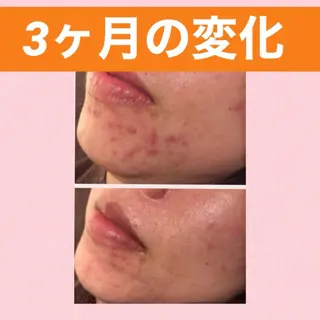 メンズ キッズ ニキビ 専門のエステ・リラクイメージ