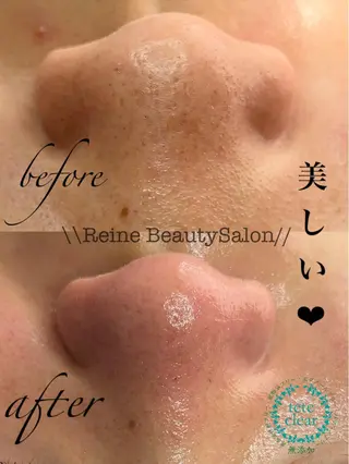 Reine BeautySalon所属・毛穴/シミ肝斑/脱毛 横山梨里のエステ・リラクイメージ