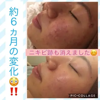 ミディアム パーマ ヘアアレンジ メンズ キッズ ネイル マツエク・マツパ ニキビ・肌質改善専門 ♡人生が変わるサロンのエステ・リラクイメージ