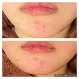 セミロング カラー パーマ ヘアアレンジ メンズ キッズ ネイル マツエク・マツパ アイブロウ ニキビ特化型エステ 🍓最短で肌質改善のエステ・リラクイメージ